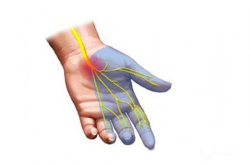 ЭНМГ ЭлектроНейроМиоГрафия